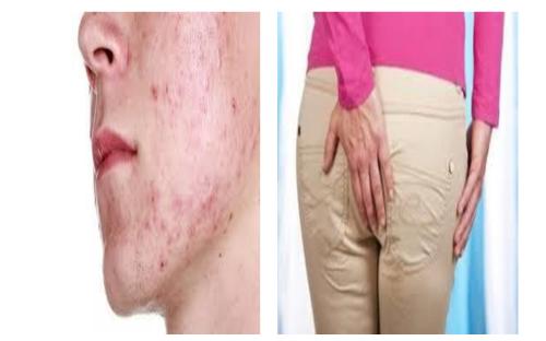 Предотвращение заражения дипилидиозом человека