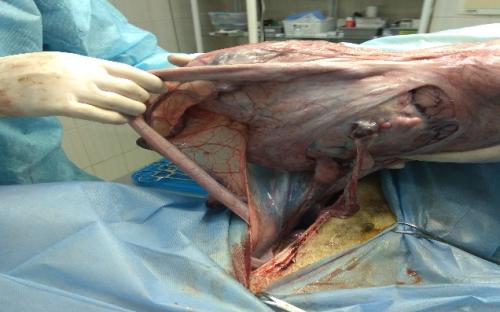 Новообразования (опухоли) яичников: заболеваемость и факторы риска